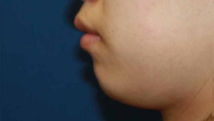 ヒアルロン酸（顎）の施術前の写真