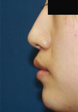 ヒアルロン酸（鼻）の施術後の写真