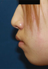 ヒアルロン酸（鼻）の施術前の写真