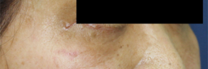 下眼瞼リフトの施術後斜面の写真