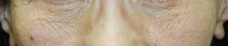 下眼瞼リフトの施術後正面の写真