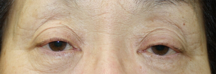 眼瞼下垂手術の施術前の写真