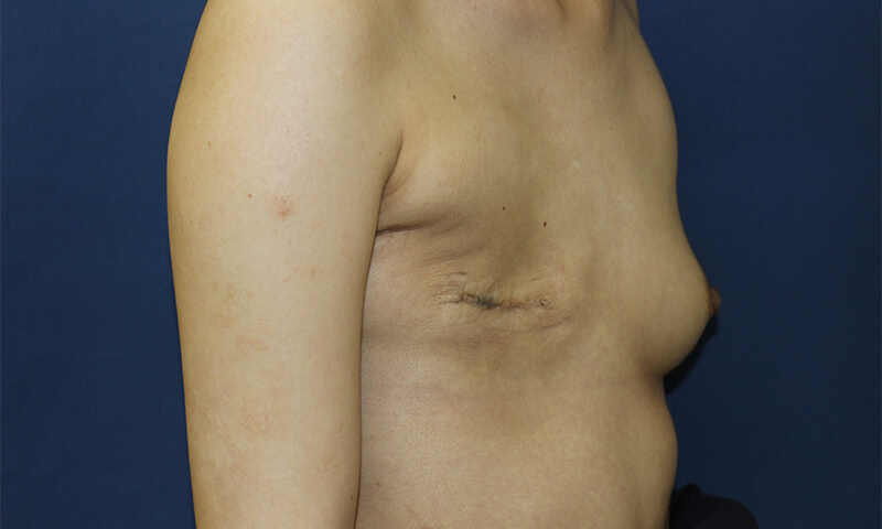 乳房再建の施術後の写真