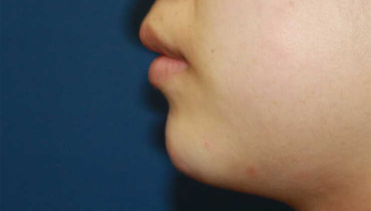 ヒアルロン酸（顎）の施術後の写真