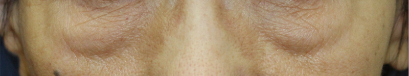 下眼瞼リフトの施術前正面の写真