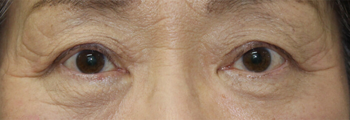 眼瞼下垂の施術後の写真