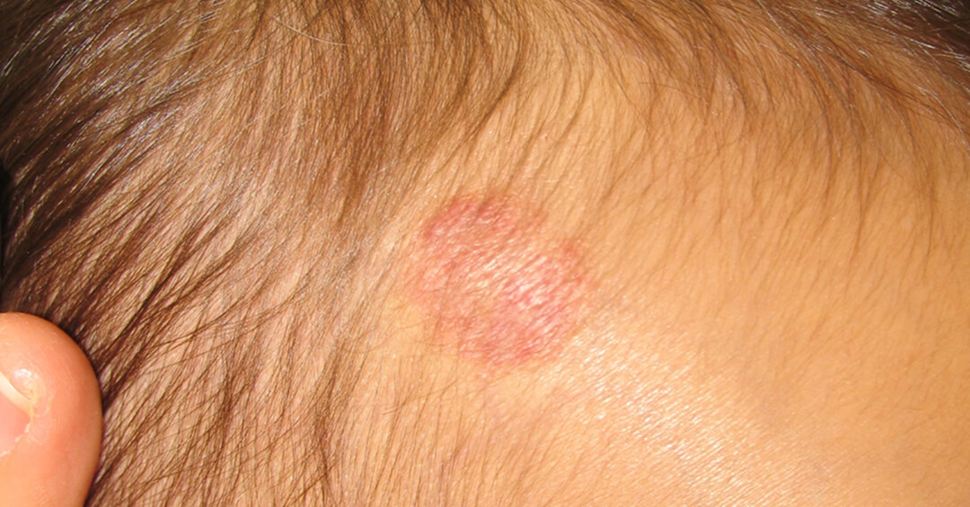 いちご状血管腫の施術後の写真