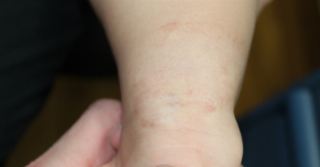 いちご状血管腫の施術後の写真