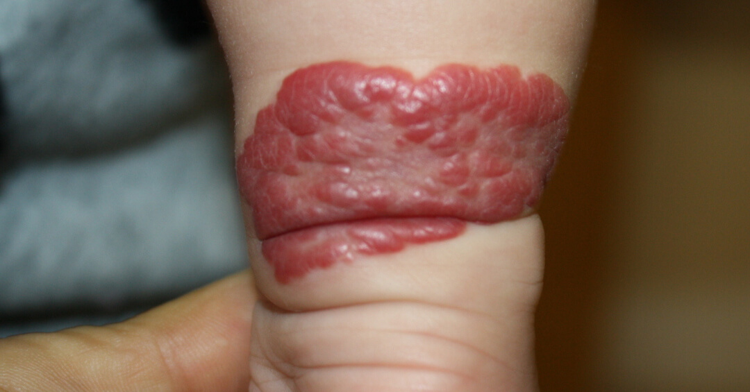 いちご状血管腫の施術前の写真