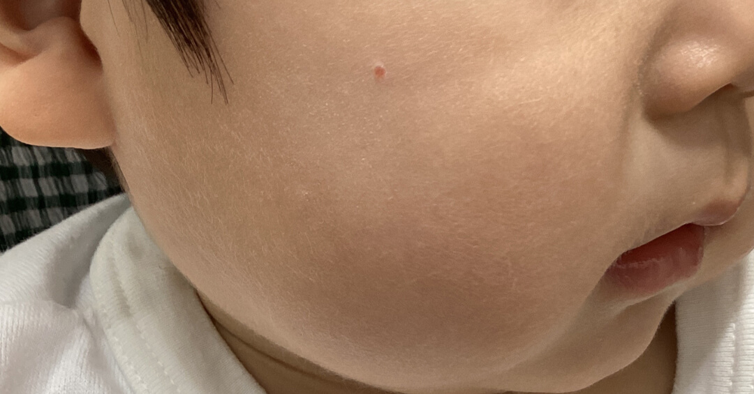 いちご状血管腫の施術前の写真