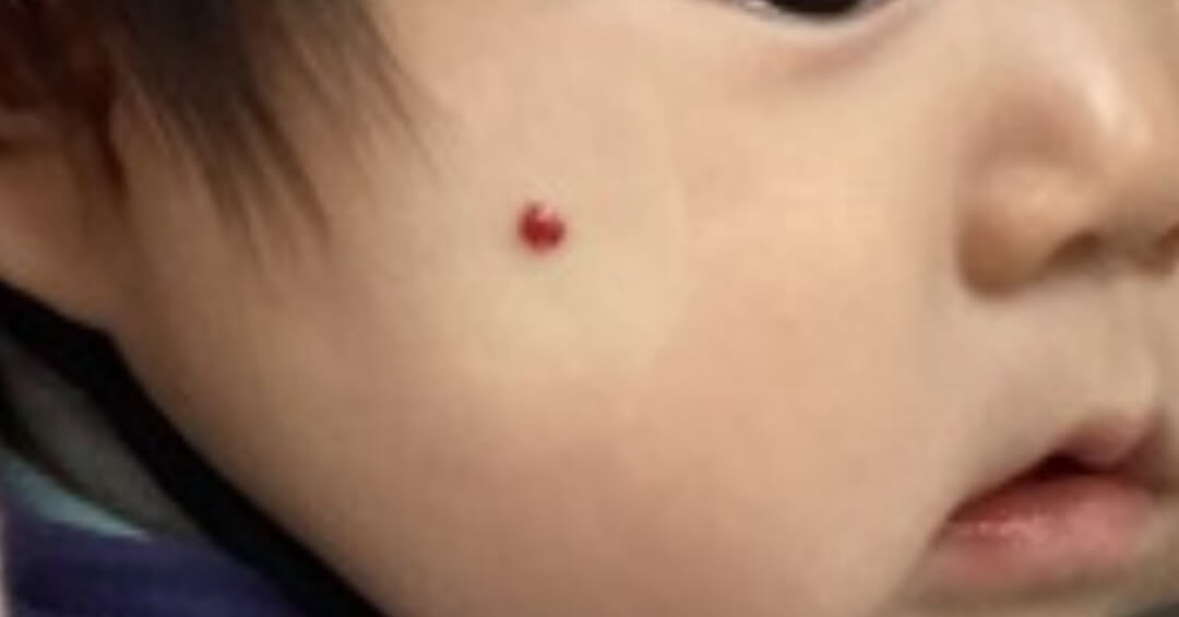 いちご状血管腫の施術前の写真