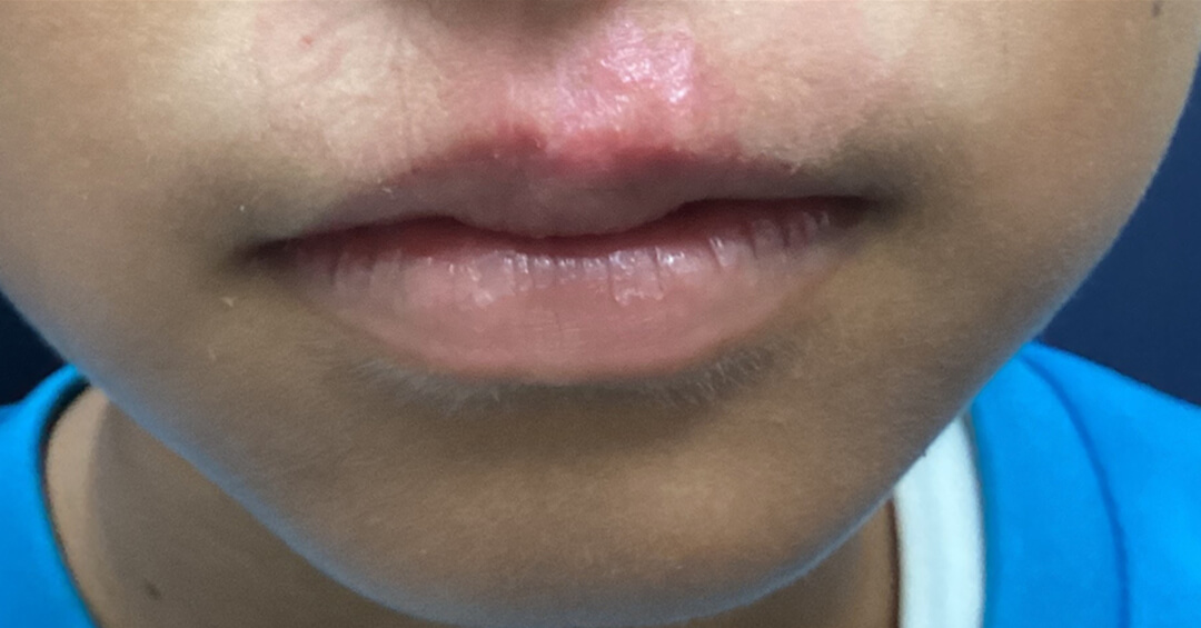 外傷の施術後の写真