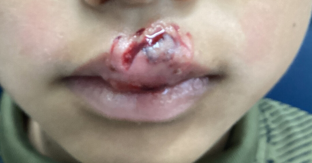 外傷の施術前の写真