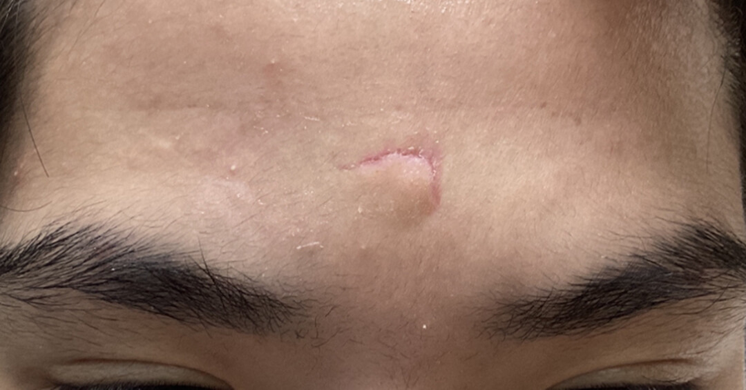 外傷の施術後の写真