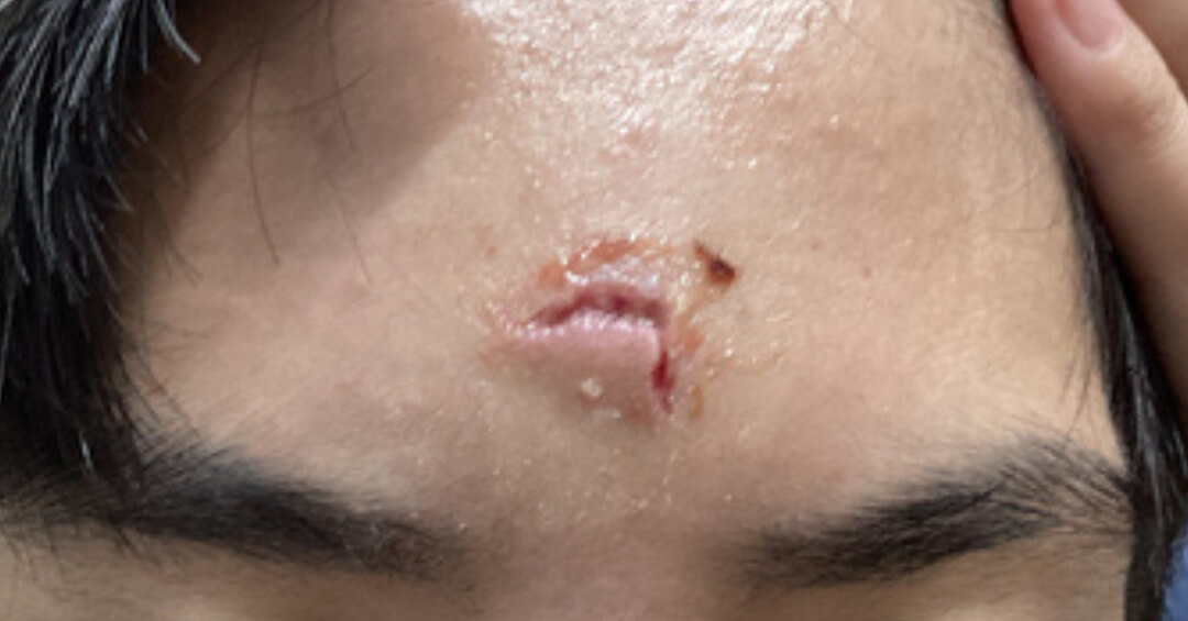 外傷の施術前の写真