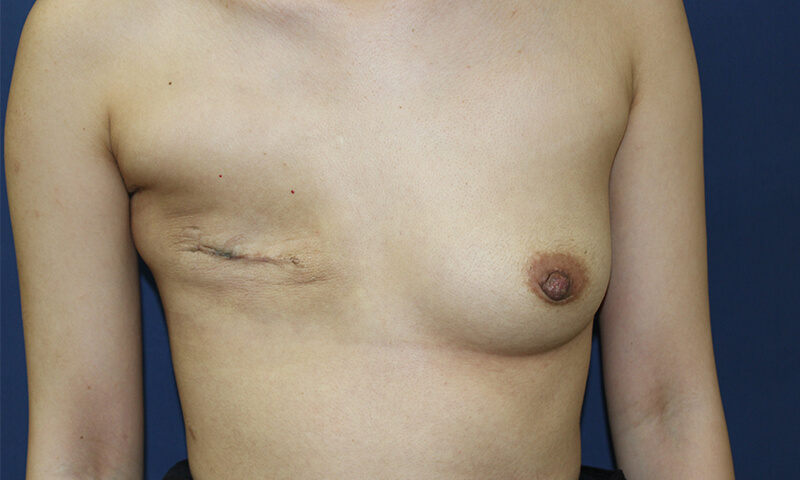 乳房再建の施術前の写真