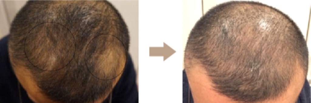 パラメディカルアート脱毛症（頭髪カモフラージュ）の施術写真