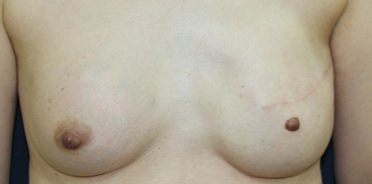 乳頭移植の写真