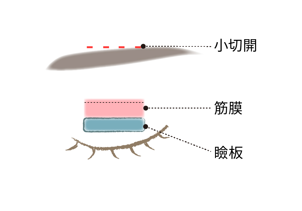 目もと 二重・眼瞼下垂・下まぶたのたるみ | 河田外科形成外科