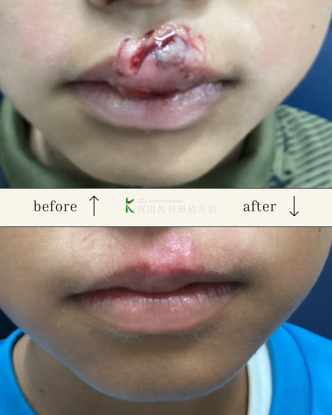 けが・火傷 - 河田外科形成外科