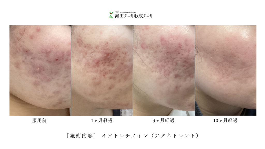 イソトレチノイン（アクネトレント）症例写真