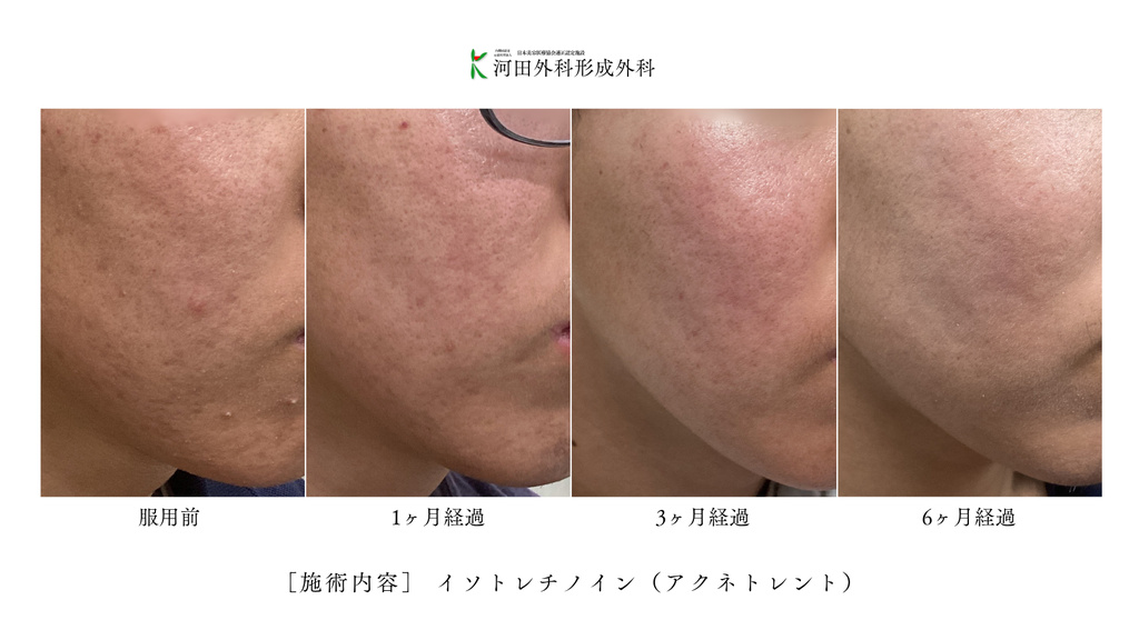 イソトレチノイン（アクネトレント）症例写真