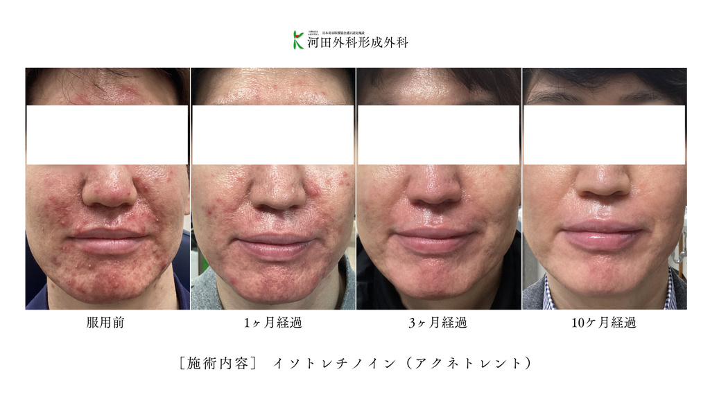 イソトレチノイン（アクネトレント）症例写真